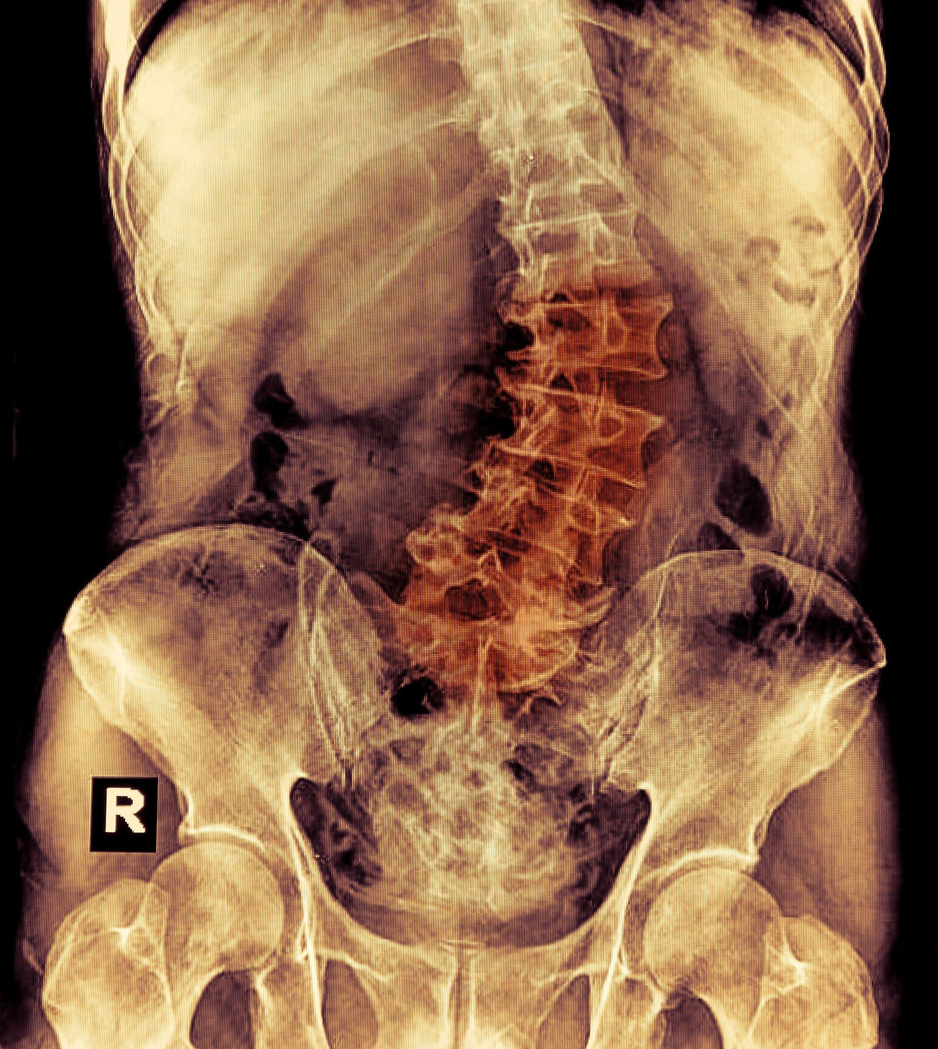 Consequences of poor Spine Alignment Before and After