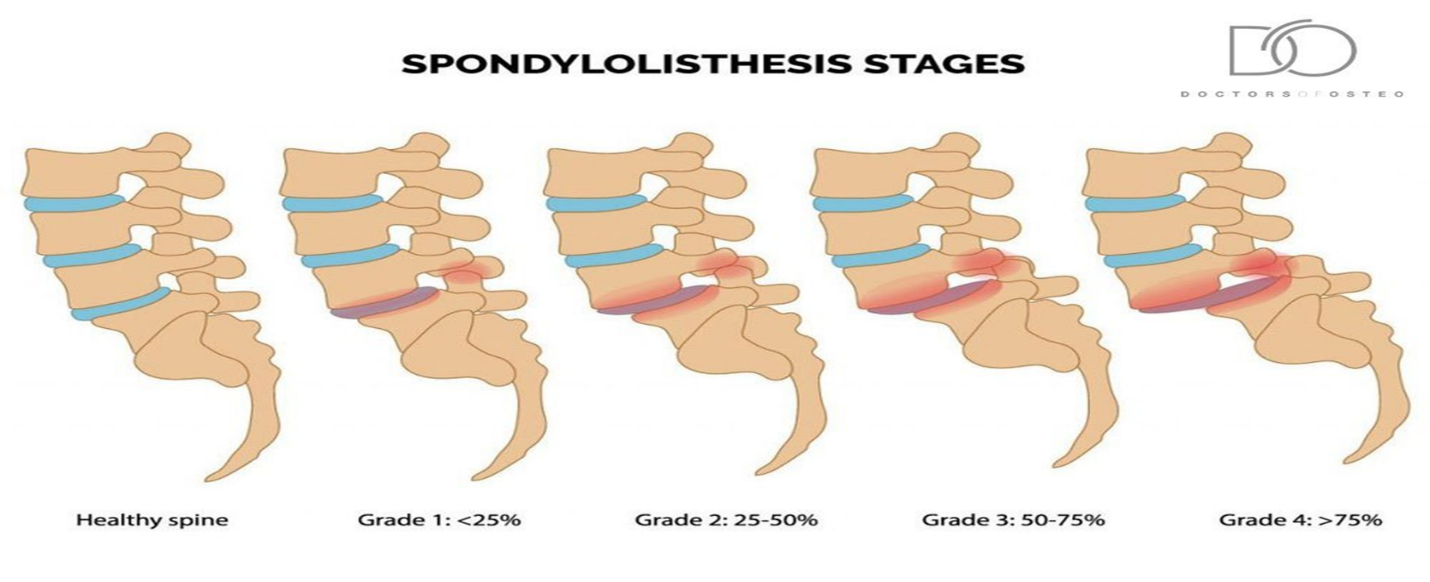 Spondylolisthesis