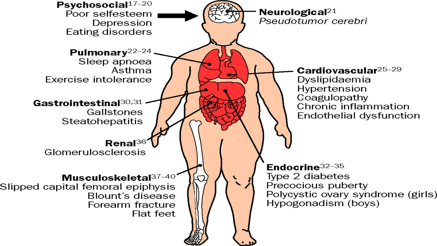 The Impact of Obesity on Spine Health,