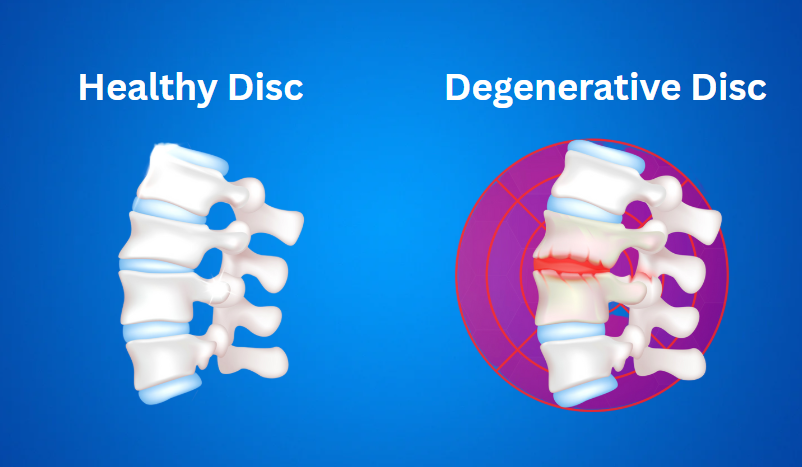 Accelerated Disc Degeneration