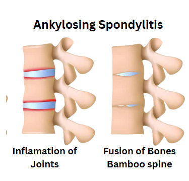 Ankylosing Spondylitis