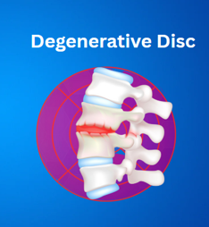 Degenerative Disc Disease