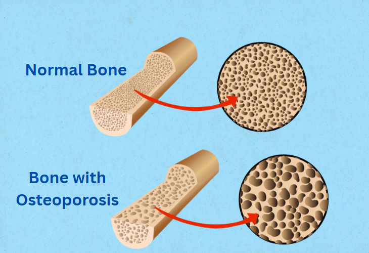 Increased Risk of Osteoporosis