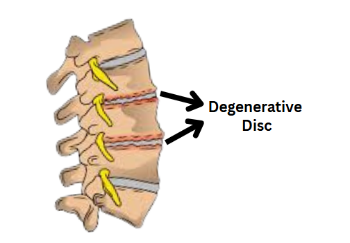 Intervertebral Disc Degeneration