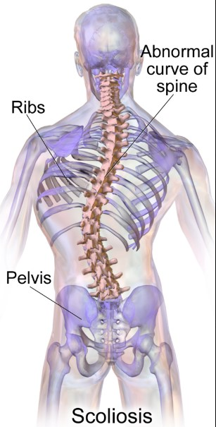 Scoliosis