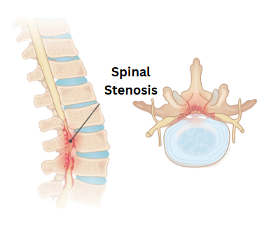 Spinal Stenosis
