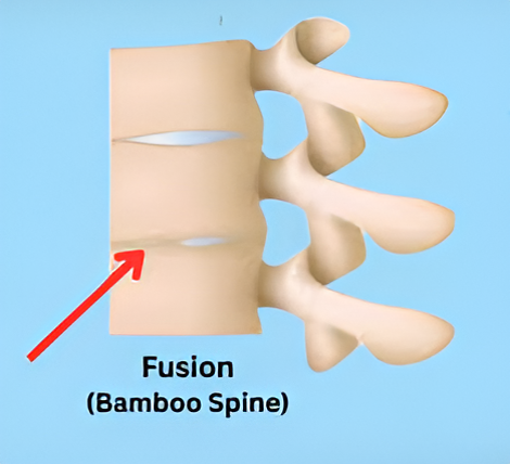 Bamboo Spine