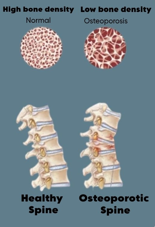 Decreased Bone Density