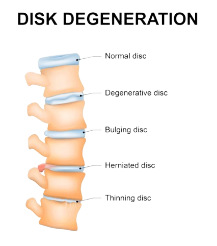 Disc Denegration