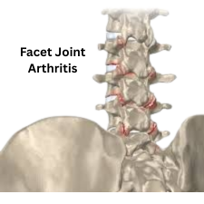 Facet Joint Arthritis
