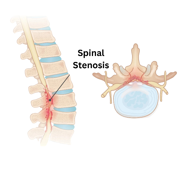 Spinal Stenosis