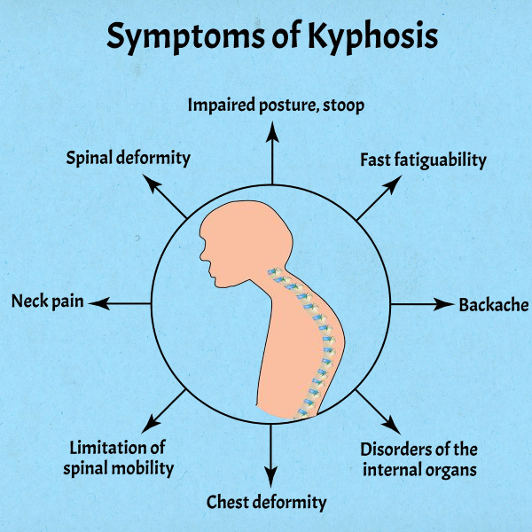 Symptoms of Kyphosis