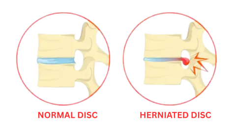 McKenzie Method of Mechanical Diagnosis and Therapy