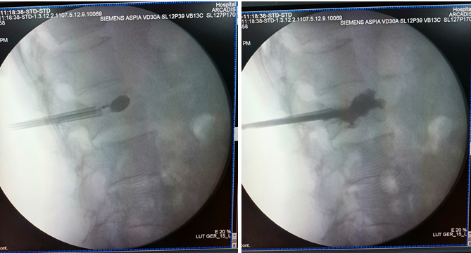 What is Kyphoplasty