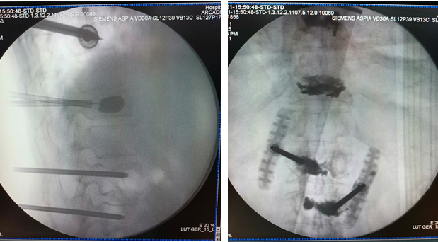 What is Multilevel Kyphoplasty