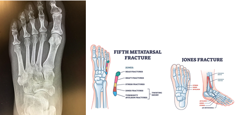 Jones fractures