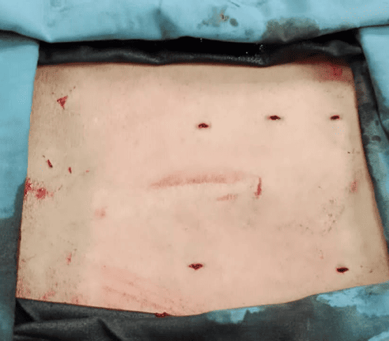 Intraoperative Phase