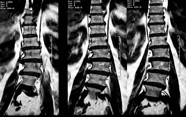 Lumbar Scoliosis