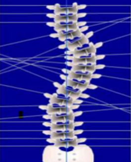 Spinal Biomechanics Lateral Displacement