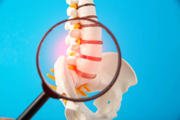 Spondylolisthesis