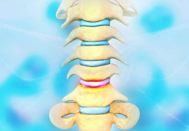 Degenerative Disc Disease,