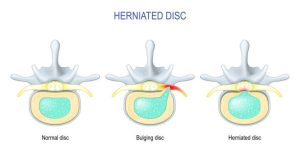 4 Types of Disc Herniation