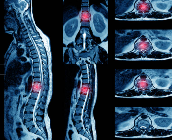 Identifying Spine TB Symptoms Early Signs Diagnosis and Treatment Options