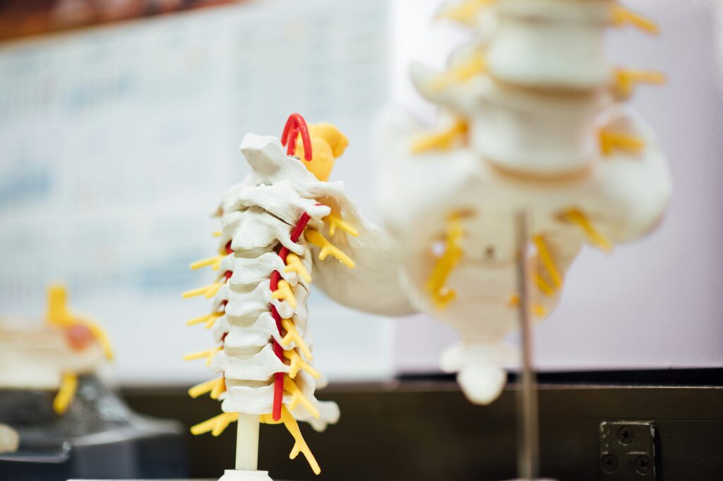 Thoracic Spinal Stenosis,