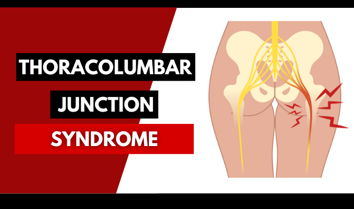 Thoracolumbar Junction Syndrome Causes, Symptoms, Diagnosis, and Treatment