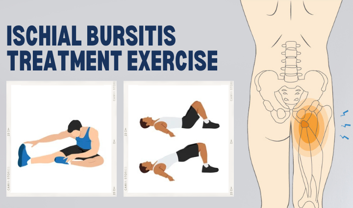 Ischial Bursitis Treatment Exercises for Pain Relief