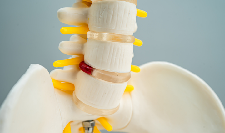 Understanding Multilevel Thoracolumbar Spondylosis Symptoms, Causes, Treatment, and Management