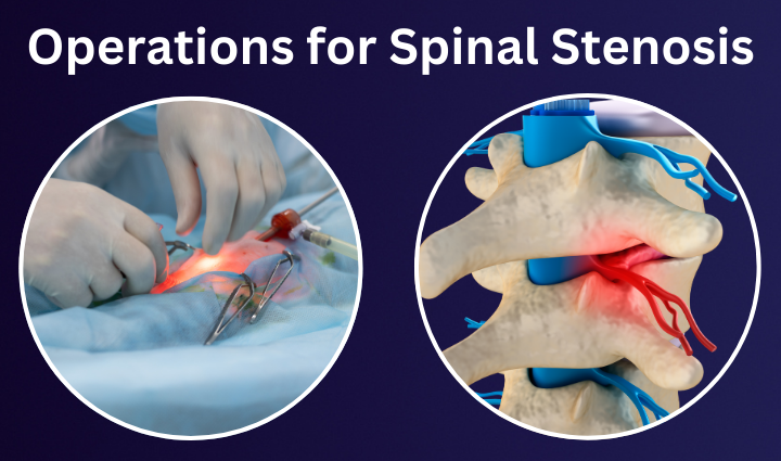 Operations for Spinal Stenosis Effective Surgical Treatments