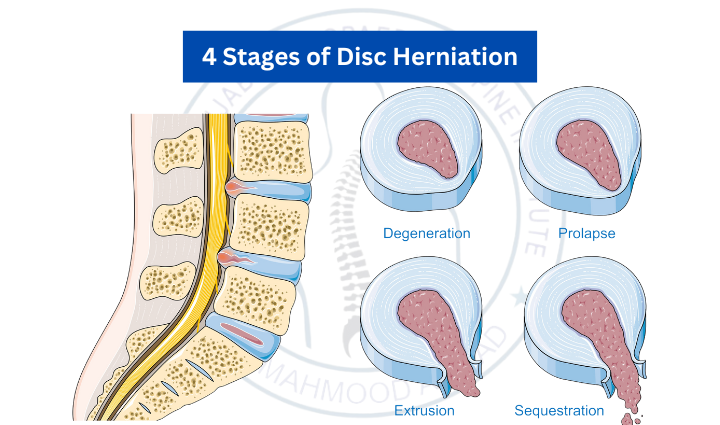 The 4 Stages of Disc Herniation Understanding and Recovery