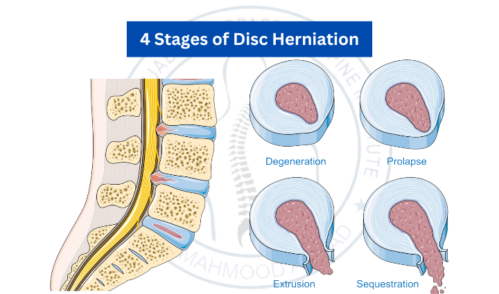 Should I Run With A Herniated Disc Detroit Chinatown Should I Run With A Herniated Disc Detroit Chinatown