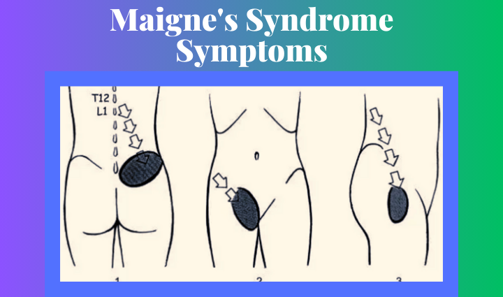 Maigne's Syndrome Symptoms,