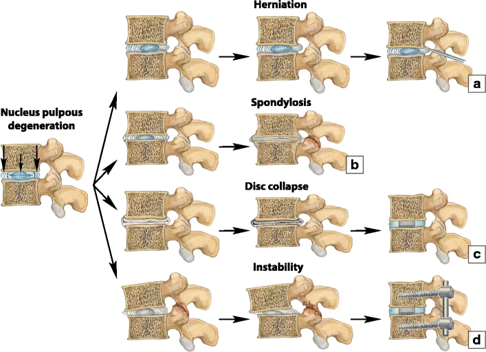 Types of Disc Disease A Comprehensive Guide for Better Spinal Health