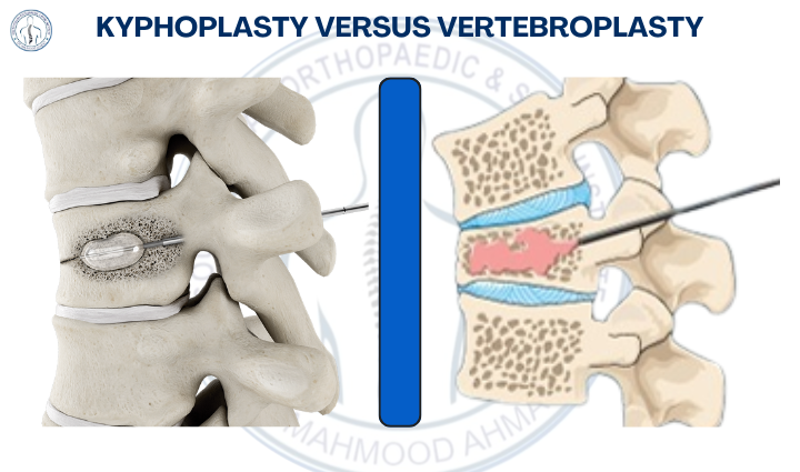 Kyphoplasty Versus Vertebroplasty