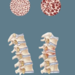 Role of Physical Therapy in the Management of Osteoporosis-Related Spinal Fractures