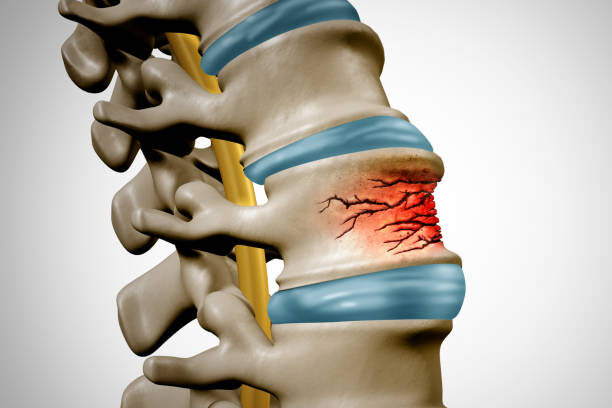 Fracture of Spine