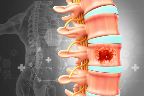 Infections of Spine Discitis