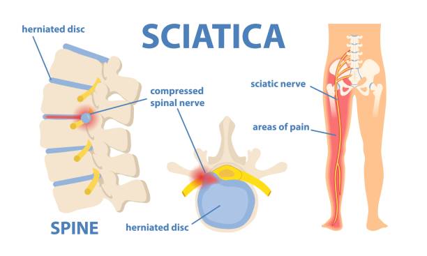 Prolapsed Disc and sciatica
