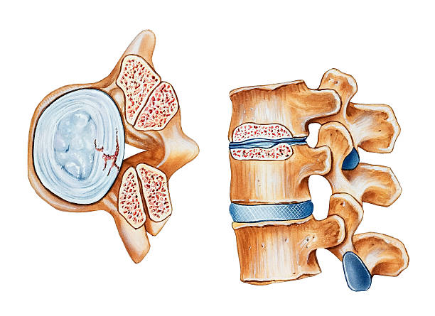 Spinal Stenosis