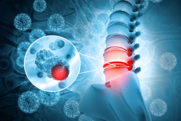 Tumors of Spinal Cord