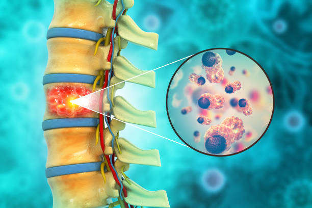 Tumors of Spine
