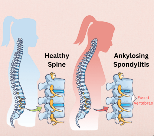 Ankylosing Spondylitis