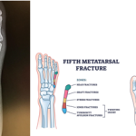 Jones Fracture